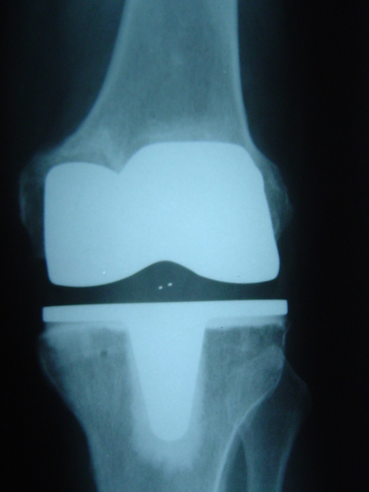 Post op X-Ray (Front View)